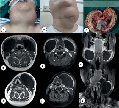 Epstein–Barr Virus-Positive Langerhans Cell Sarcoma: Is There a Link? A Case Report